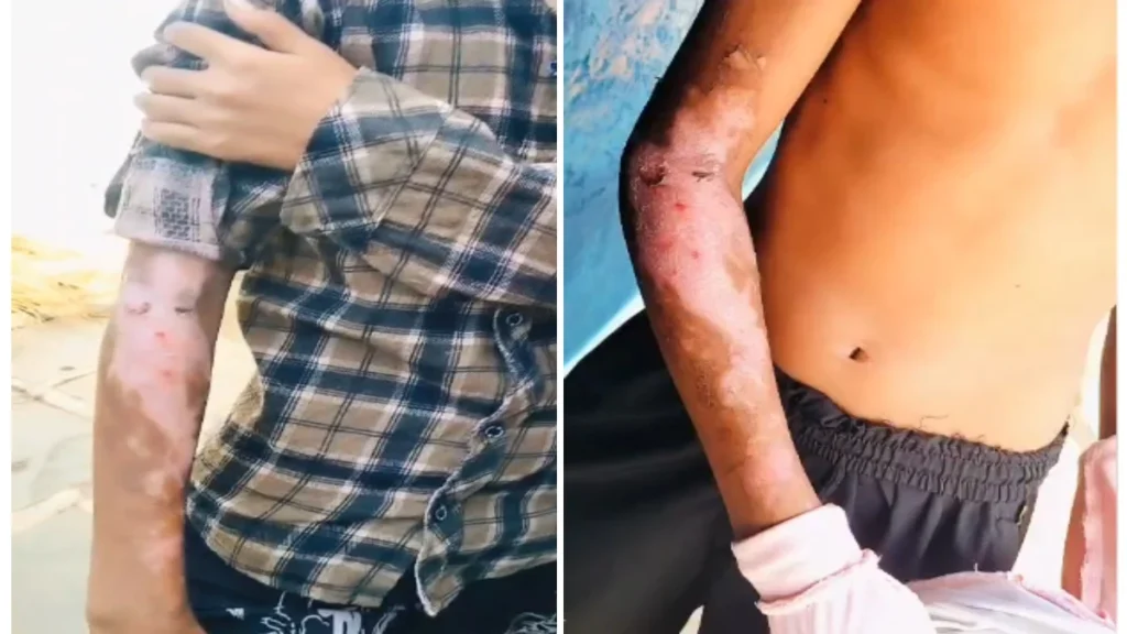 आदिवासी छात्रावास प्रबंधन की लापरवाही: रसोई में गर्म दाल से झुलसे 2 छात्र, परिजनों ने की कार्रवाई की मांग